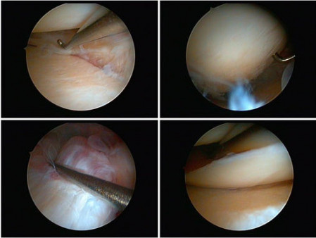 Вид через артроскоп
