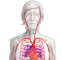 Атеросклероз сосудов шеи | Клиника доктора Шишонина