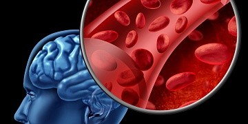 чем сбить температуру при инсульте. Смотреть фото чем сбить температуру при инсульте. Смотреть картинку чем сбить температуру при инсульте. Картинка про чем сбить температуру при инсульте. Фото чем сбить температуру при инсульте