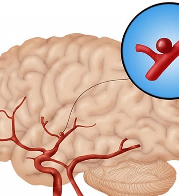 Фото Аневризма сосудов головного мозга div