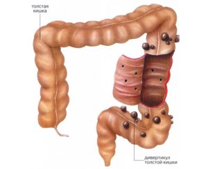 Диета при дивертикулезе кишечника меню на неделю
