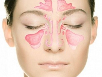 Фото Синусит