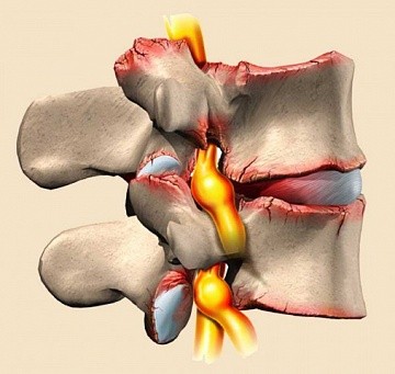 Фото Спондилез