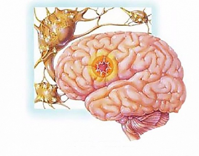 Криптогенная эпилепсия, симптомы и причины заболевания. К какому врачу ...