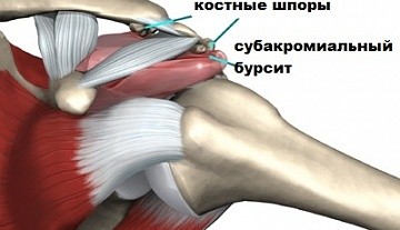 Субакромиальный бурсит, симптомы, причины, профилактика