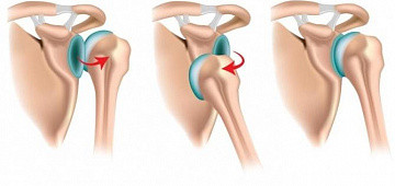 Фото Вывих плеча