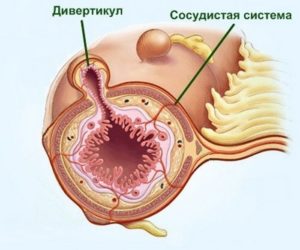 Фото Дивертикулез толстой кишки: симптомы и лечение div