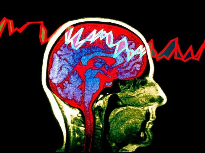 Джексоновская эпилепсия, симптомы и причины. К какому врачу обратиться?