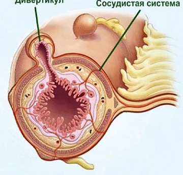 Фото Диета при дивертикулезе сигмовидной кишки 