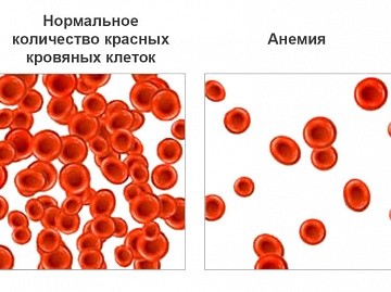 Фото Анемия