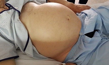 Фото Водянка