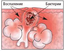 Воспаление картинки для презентации