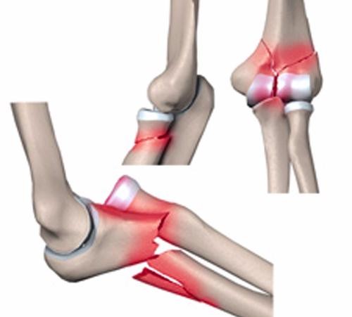 Переломы локтевого отростка