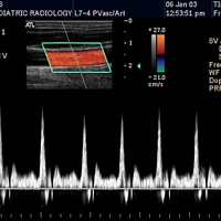 Доплерограф