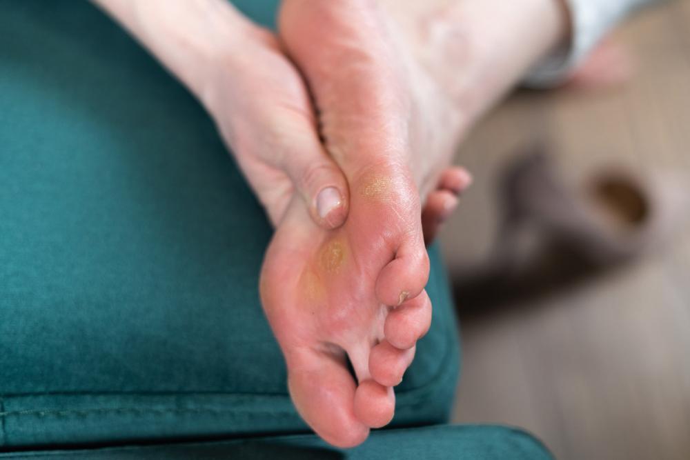 Язва на ногах