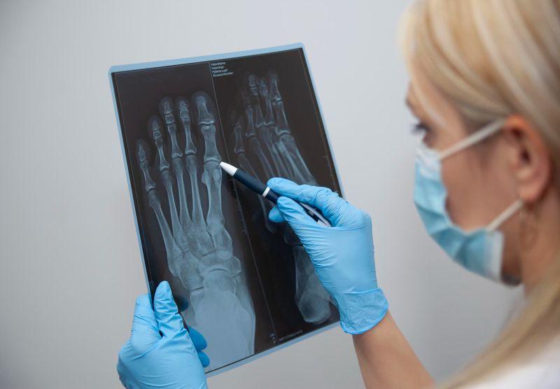 Как отличить перелом от ушиба