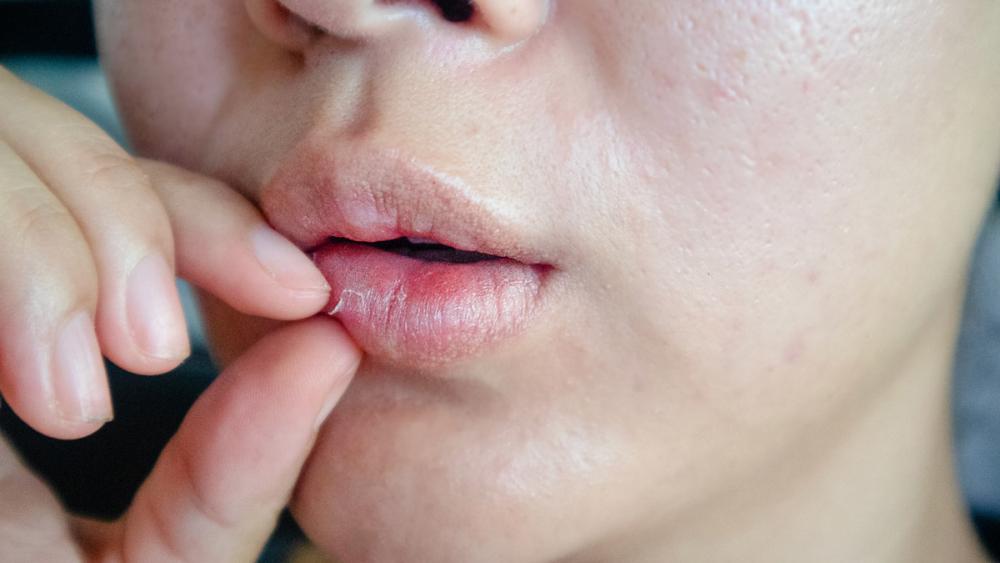 Ангулярный стоматит