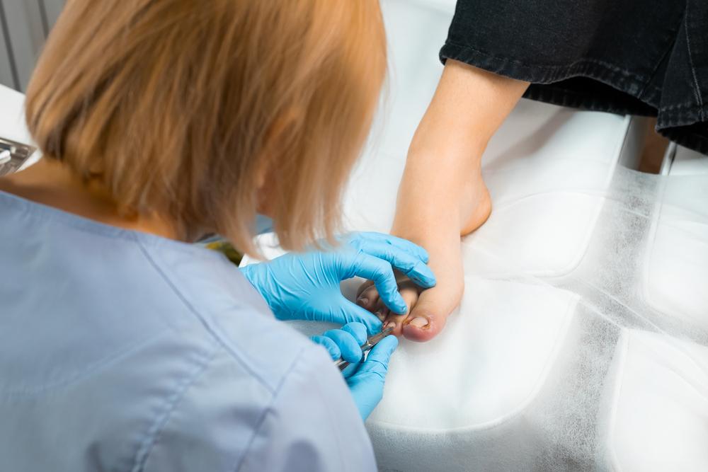 Лечение грибка ногтей