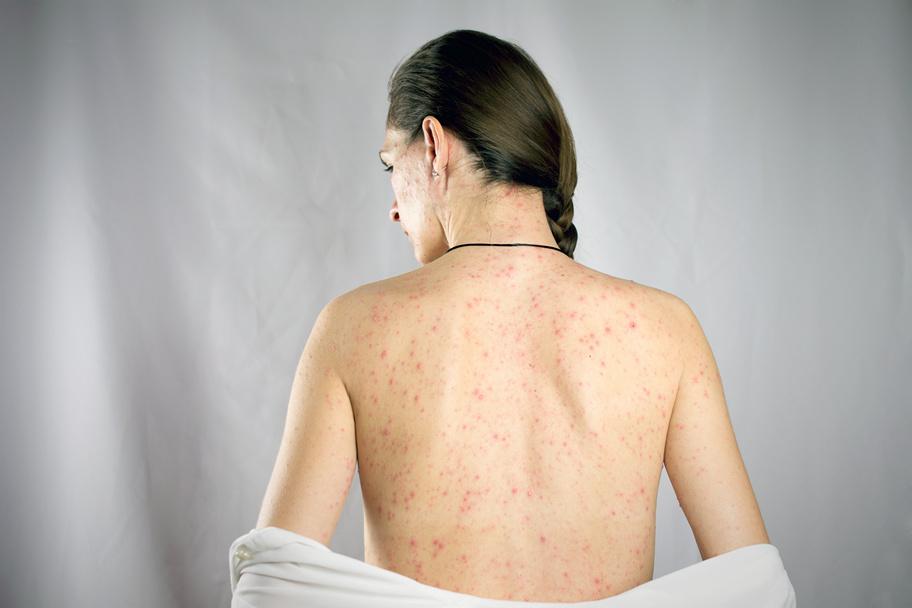 Корь у детей и взрослых