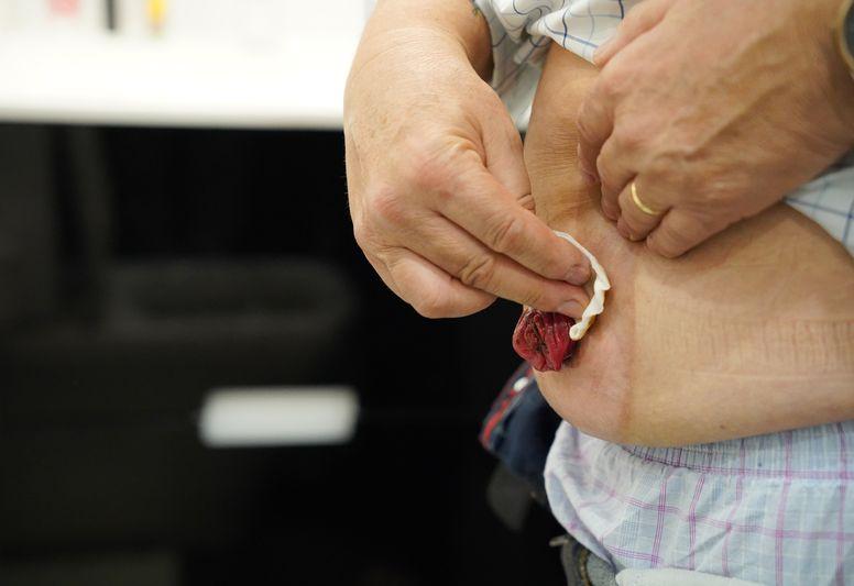 Трофическая язва при диабете