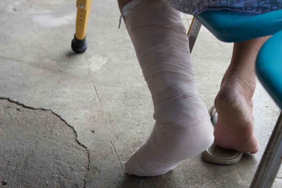 Перелом пальца на ноге