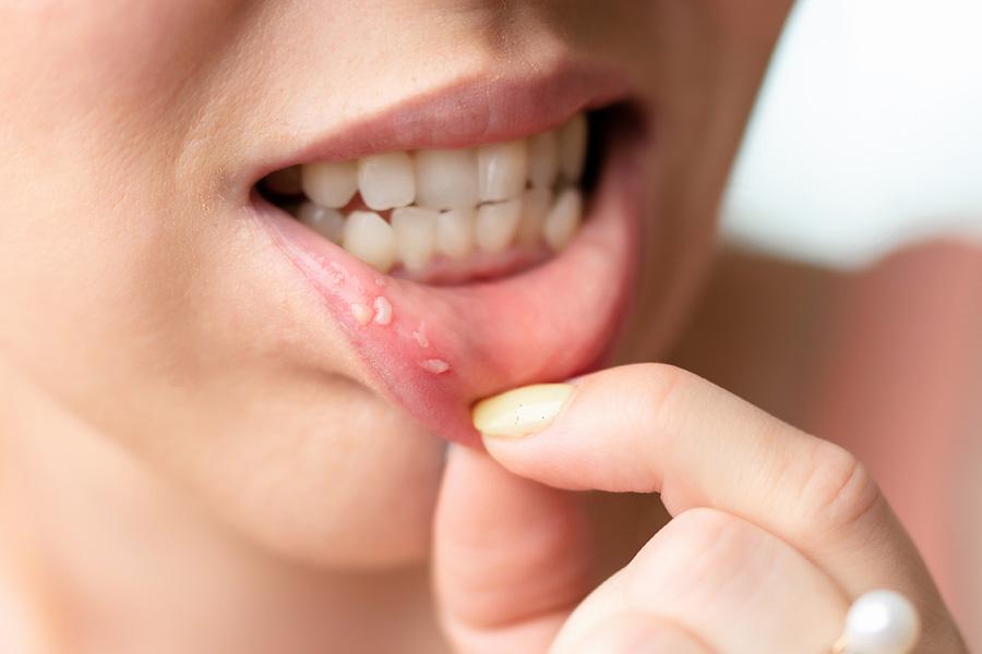 Стоматит на губе