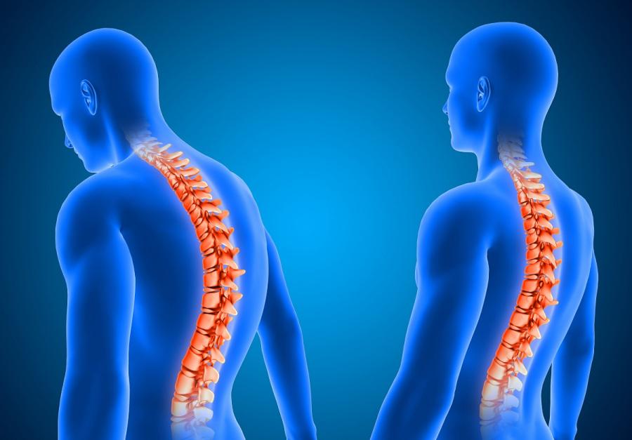 Псориатический спондилит