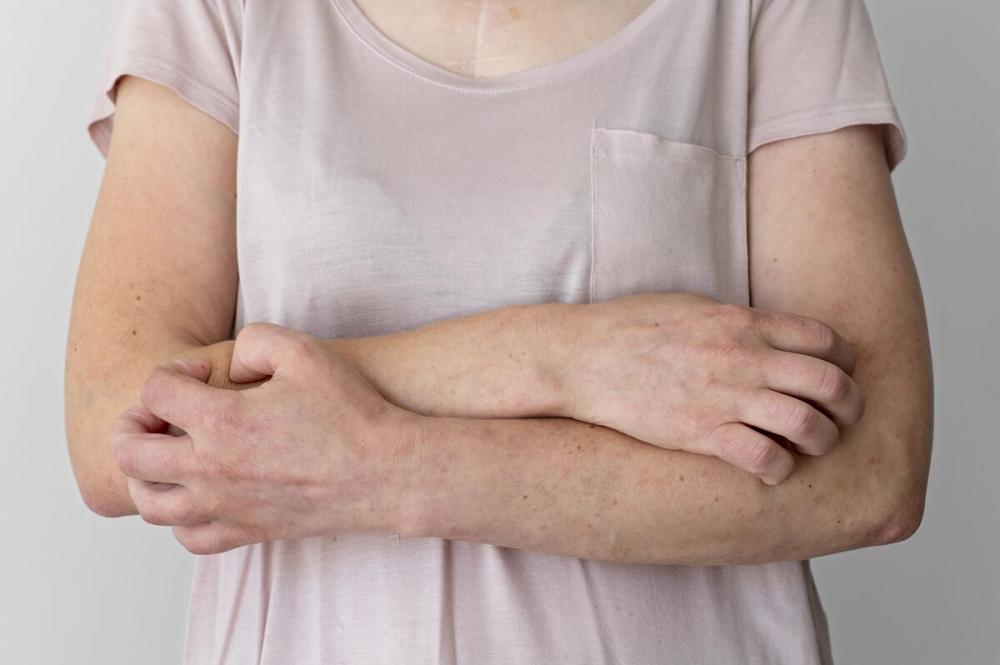 Саркоидоз кожи