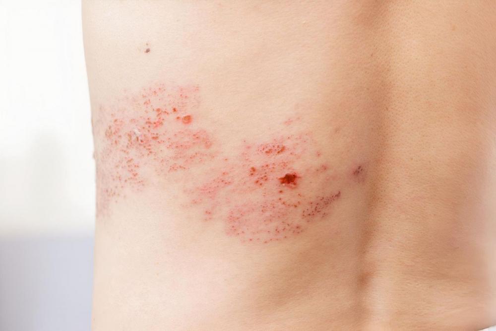 Опоясывающий лишай 