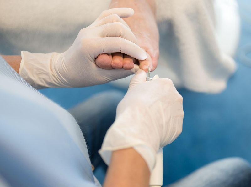 Грибок ногтей на ногах