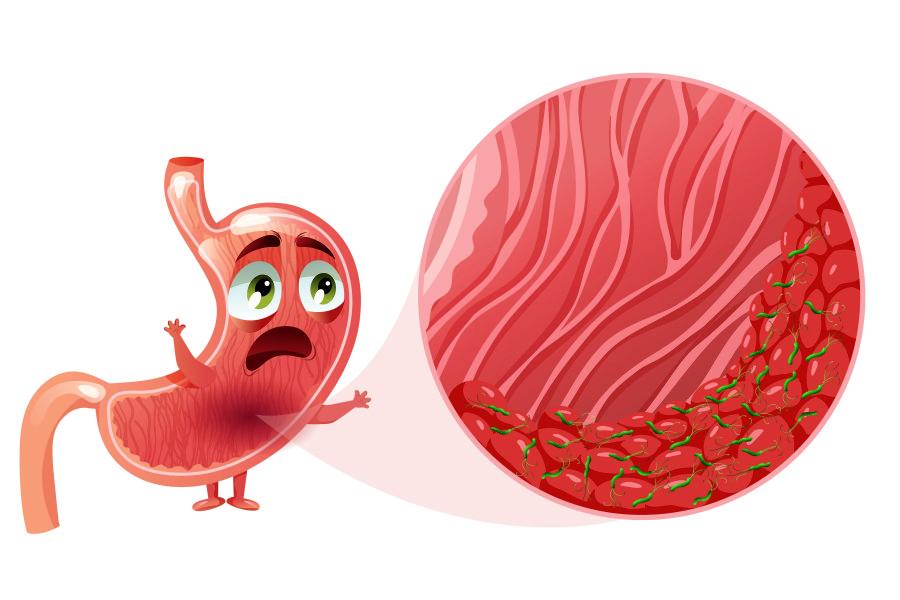 Язва пищевода