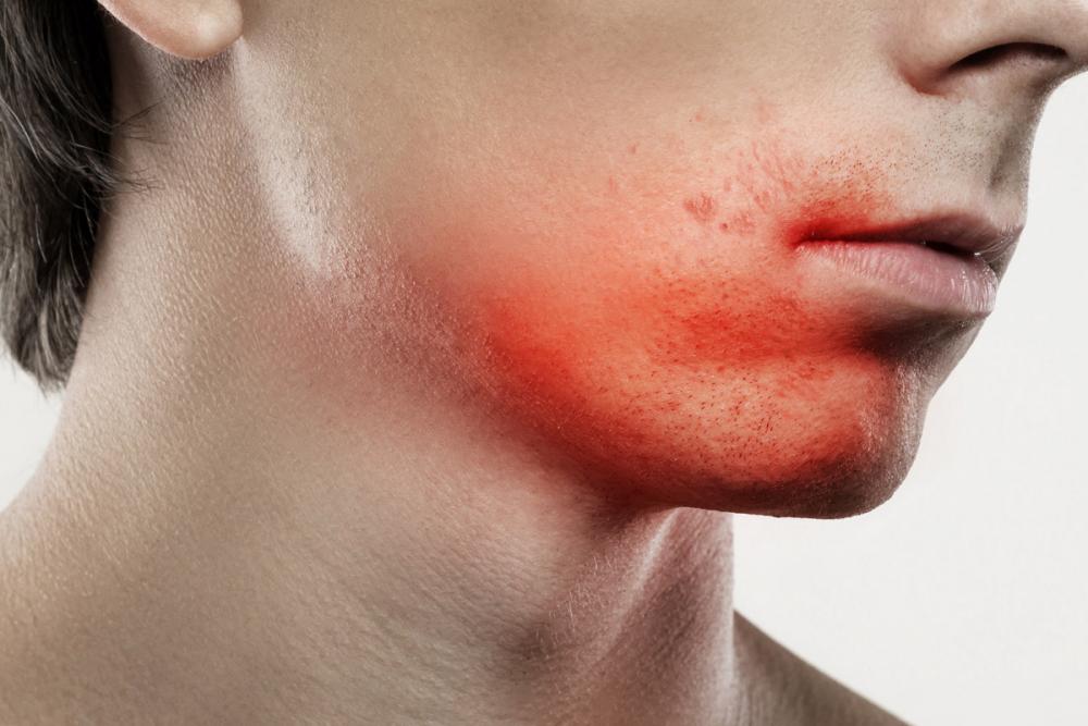 Пероральный дерматит на лице