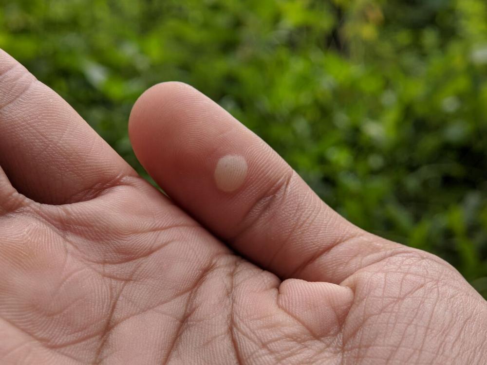 Бородавки на руках: причины и лечение