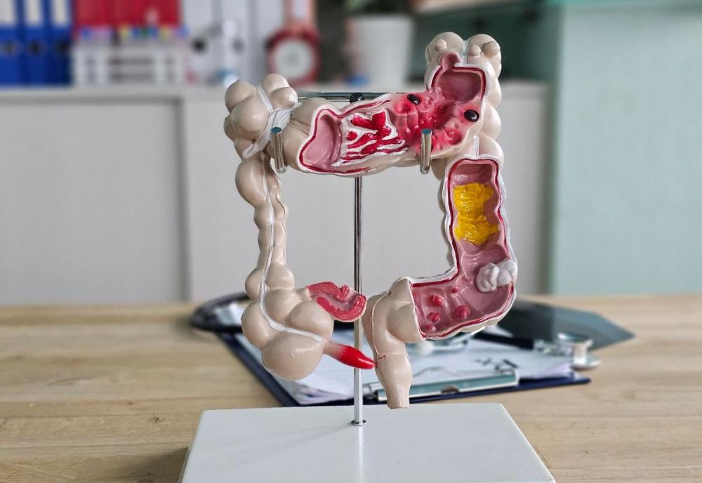 Как определить аппендицит?