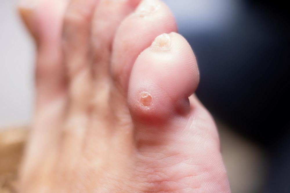 Бородавки на ногах