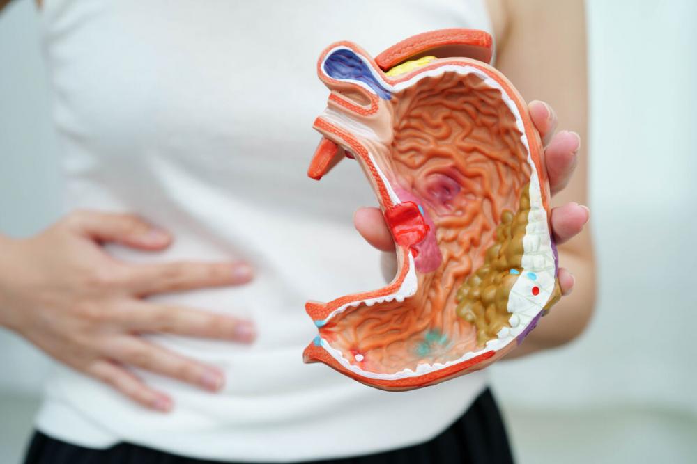 Стеноз желудка