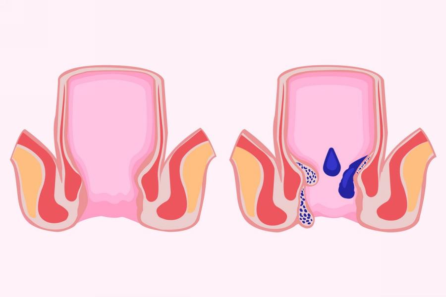 Геморрой 1 степени