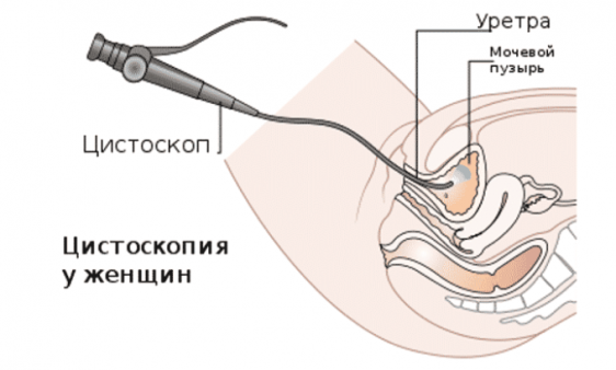 Цистоскопия мочевого пузыря - 3 