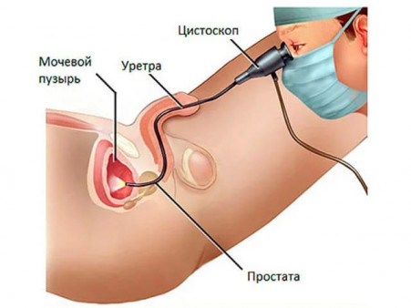 Цистоскопия мочевого пузыря - 2 