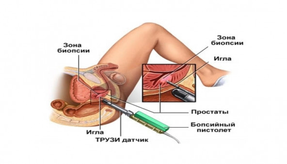 Цистоскопия мочевого пузыря - 4 