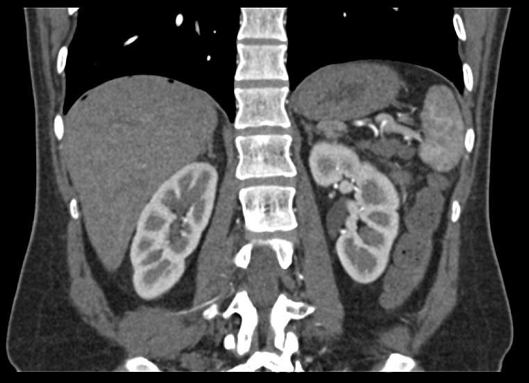 Показания к КТ брюшной полости с контрастом фото