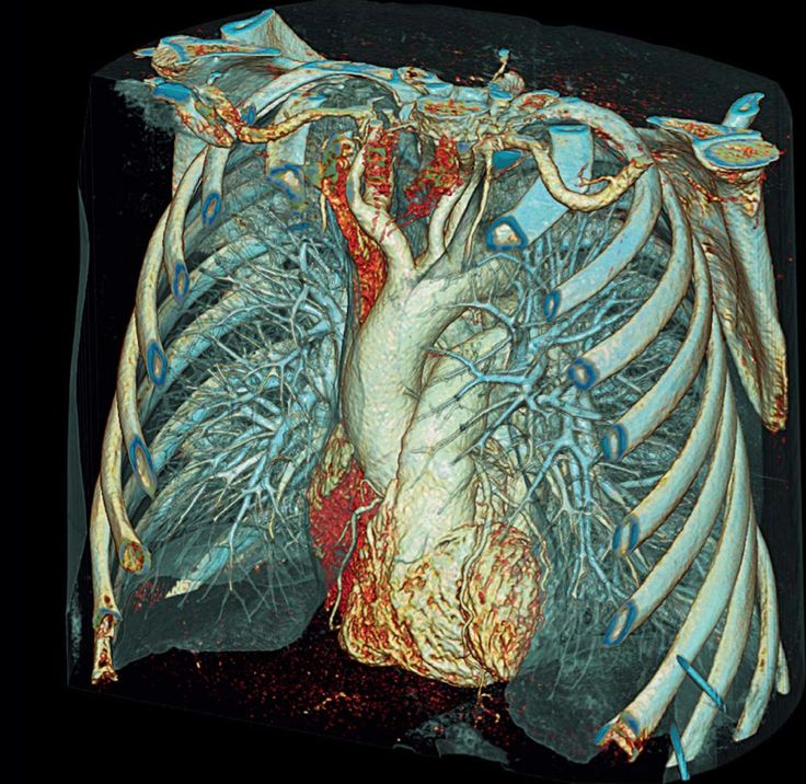 Как делают мскт грудной клетки фото