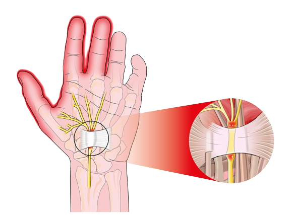 Симптомы туннельного синдрома фото