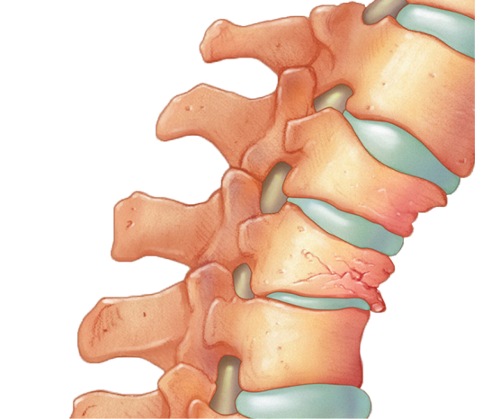 Почему возникает компрессионный перелом позвоночника фото