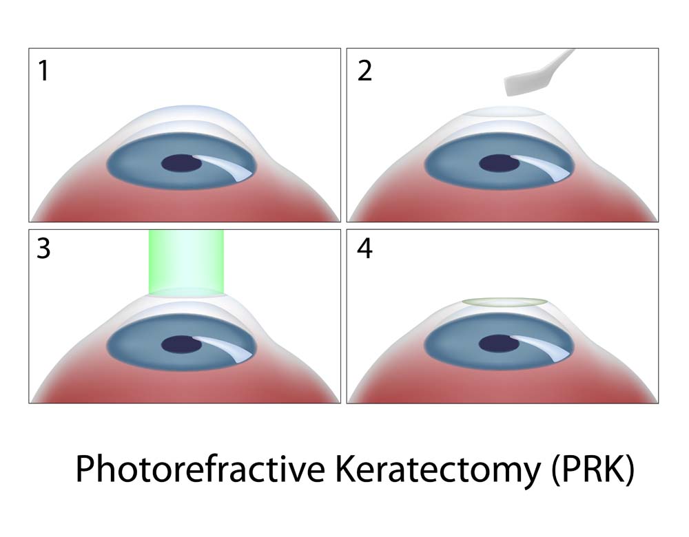 Фоторефракционная кератэктомия (ФРК, PRK)