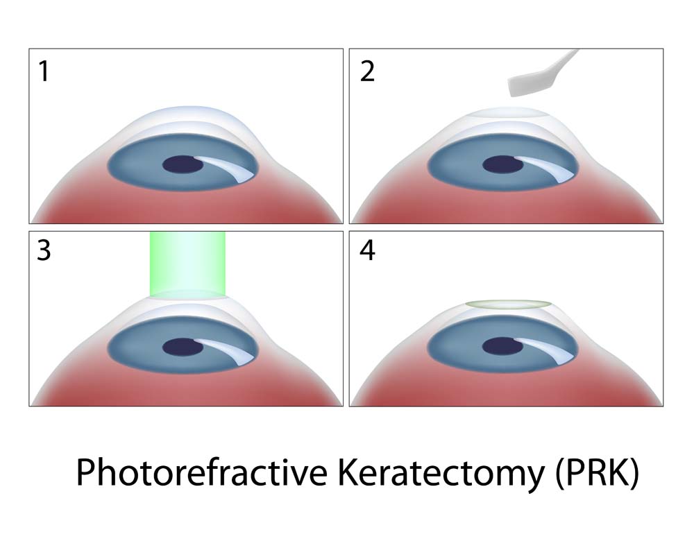 Фоторефракционная кератэктомия (ФРК, PRK) Фоторефракционная кератэктомия (ФРК, PRK)