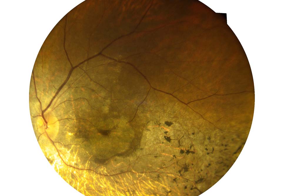 Макулодистрофия сетчатки глаза, лечение и прогноз, причины и симптомы ...