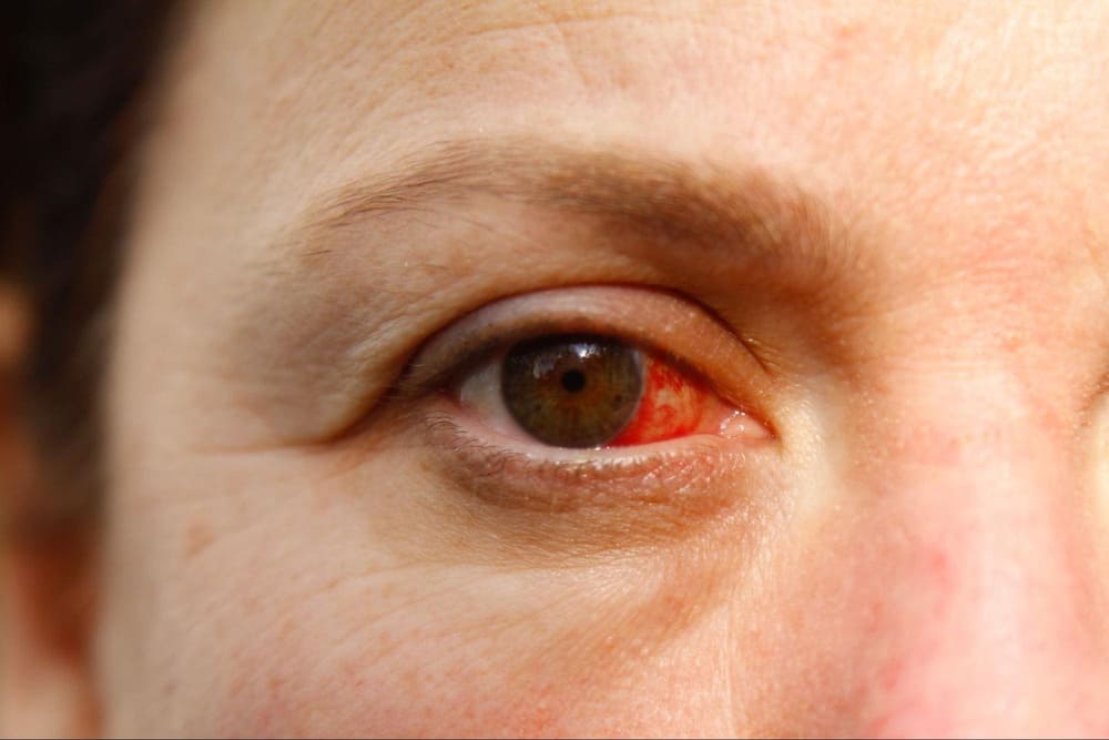 Глазные инфекции-4 Глазные инфекции-4