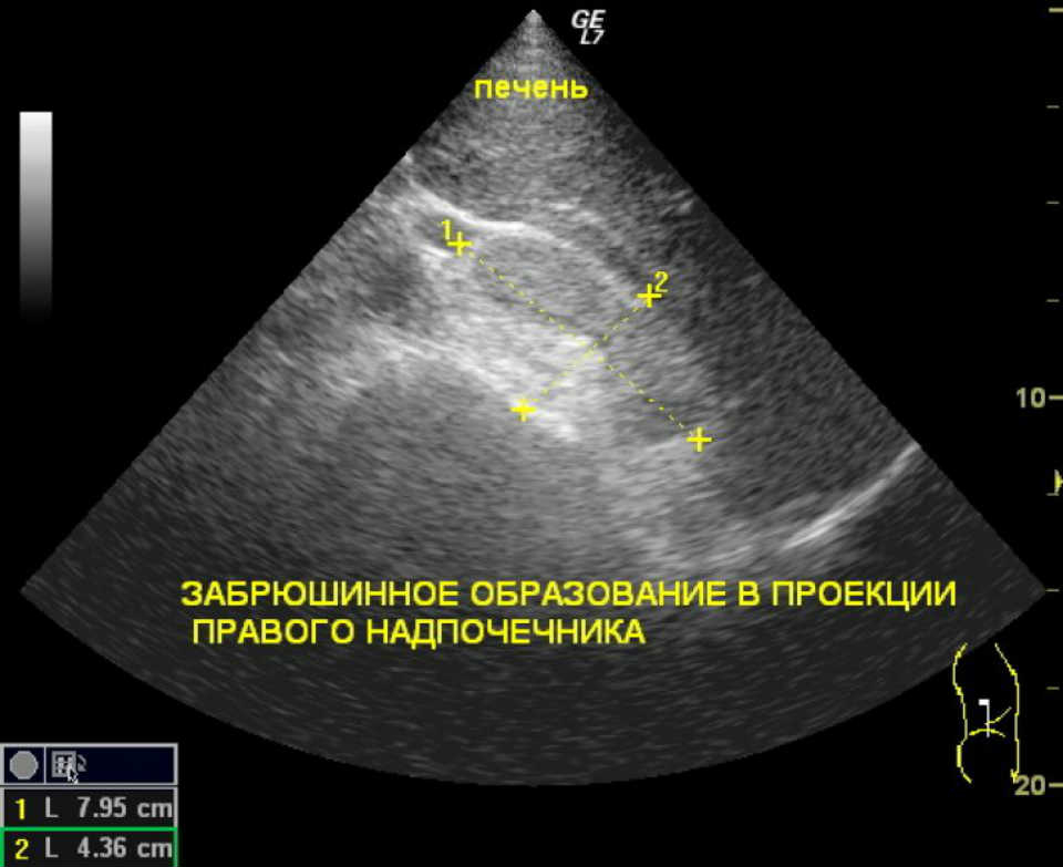 Узи надпочечников как делают у женщин фото