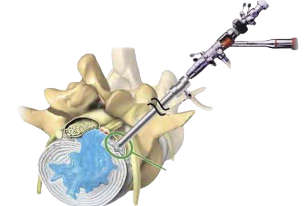 Дискэктомия поясничного отдела позвоночника схема операции